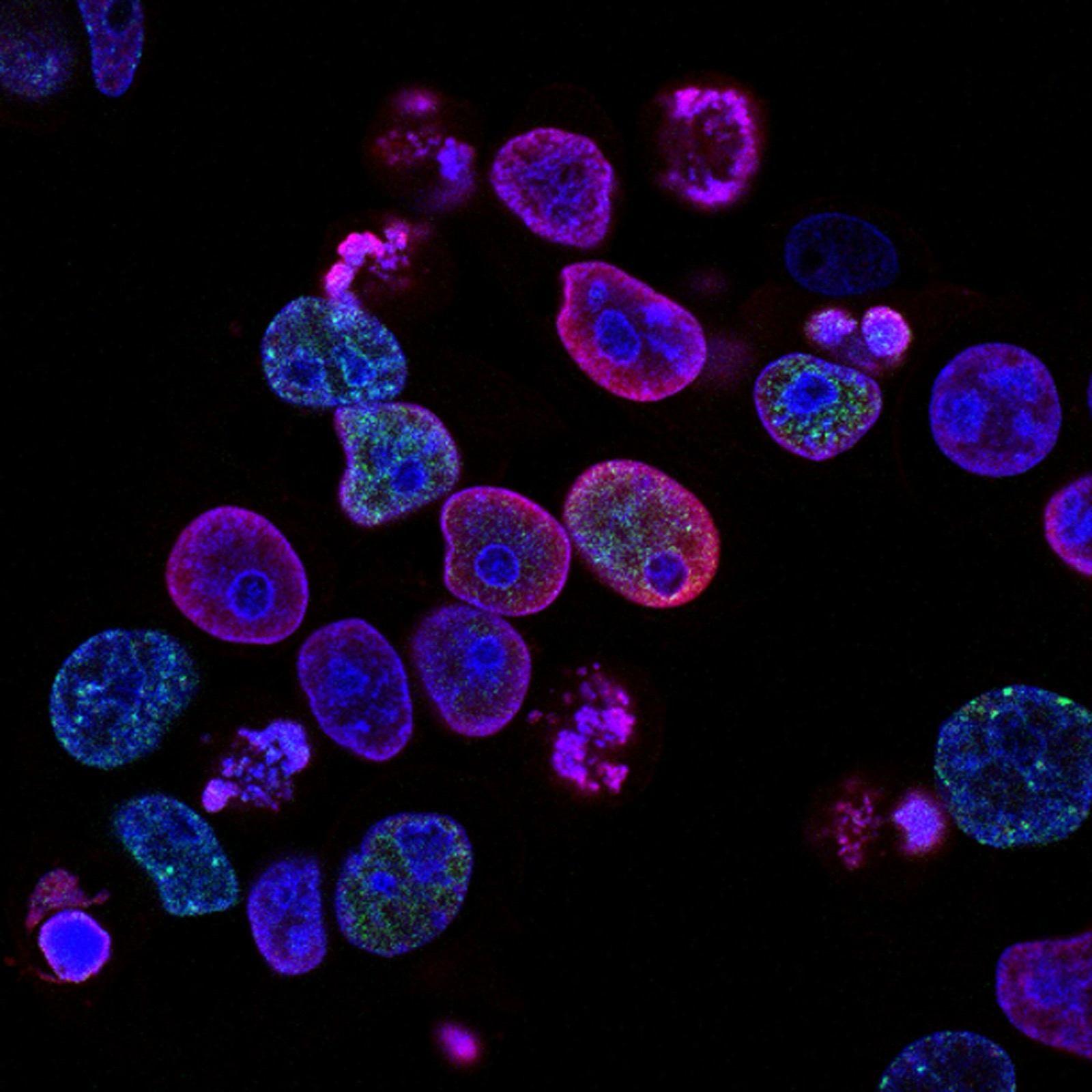 All about prostate cancer
